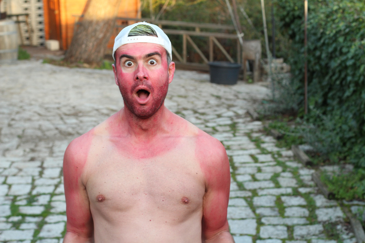 sunburned man